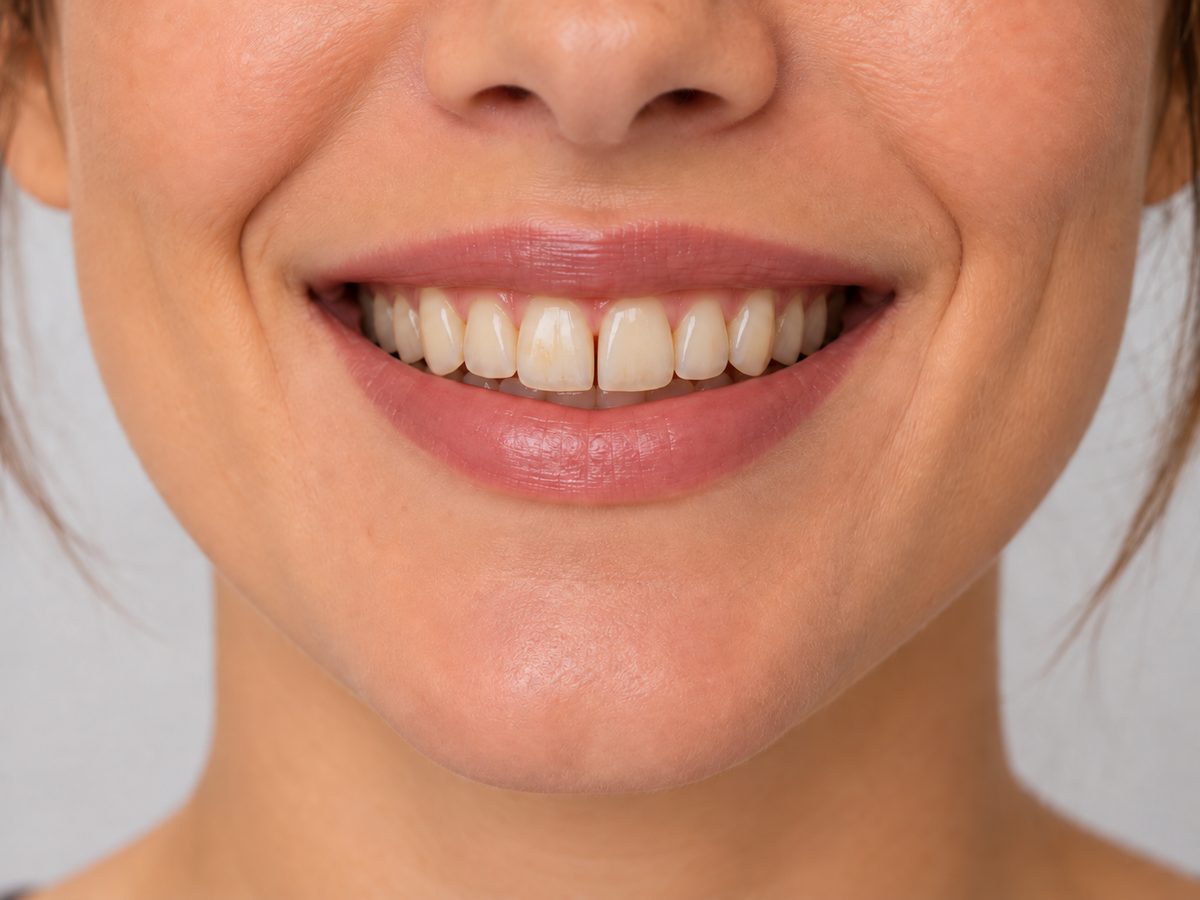 O mesmo sorriso antes do tratamento